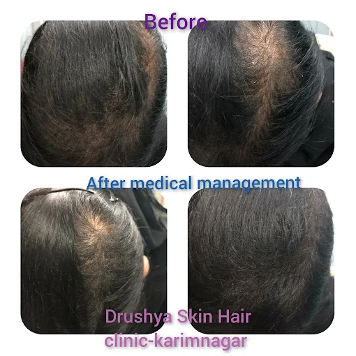 Acne Treatment Result